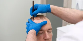 5000 Grafts Hair Transplant Cost in Pakistan