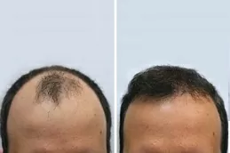 FUE Treatment Care Tips
