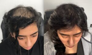 PRP Hair Treatment In Islamabad - Result 01