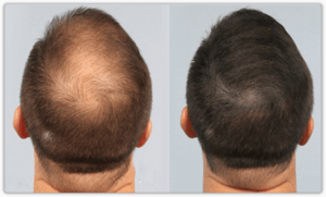 PRP Hair Treatment In Islamabad - Result 03