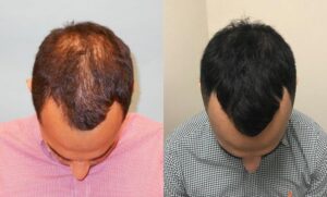 PRP Hair Treatment In Islamabad - Result 04